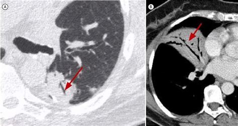 In A, an axial CT scan with lung window settings showing an air ...