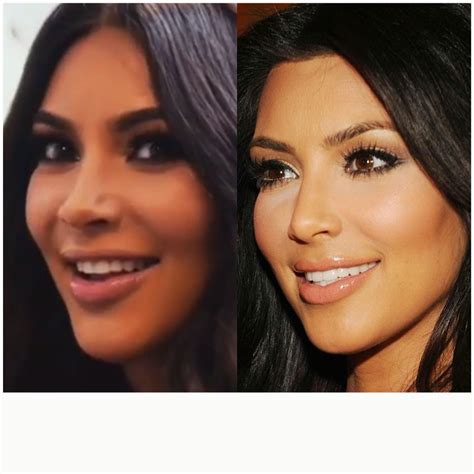 Kim kardashian Fillers and nose job before and after | Under eye fillers, Nose job, Kim kardashian