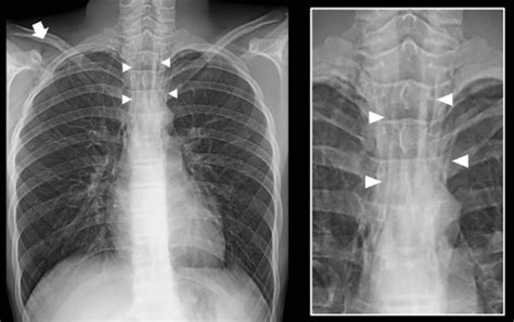 Hamman's Sign in a Patient with Spontaneous Pneumomediastinum - The Journal of Pediatrics