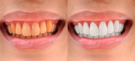 How to Whiten Teeth in Photoshop? - Welcome to Rephotosolution, background removal, clipping path