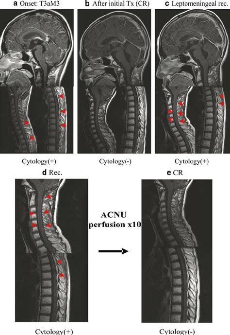 MRI scans showing the effects of IT chemotherapy. Case 1 a MRI of... | Download Scientific Diagram