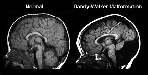 Apa Itu Dandy Walker Syndrome Penyakit Langka Yang Menyerang Adam Fabumi, WAJIB BACA