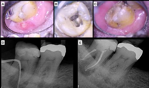 Treatment of case 2, A) Preoperative clinical aspect (sinus tract); B ...