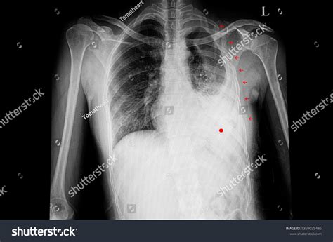 113 Flail chest Images, Stock Photos & Vectors | Shutterstock