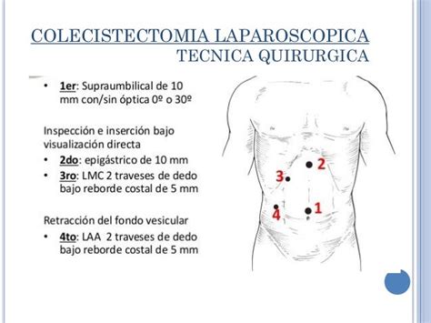 Colecistectomia laparoscopica