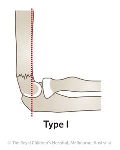 Clinical Practice Guidelines : Supracondylar fracture of the humerus - Emergency Department