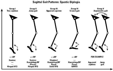 [PDF] Severe crouch gait in the sagittal gait patterns of spastic ...