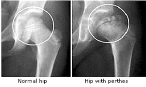 Legg calve perthes disease