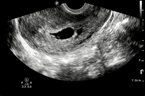 Subchorionic hemorrhage (anechoic collection) adjacent to gestational ...