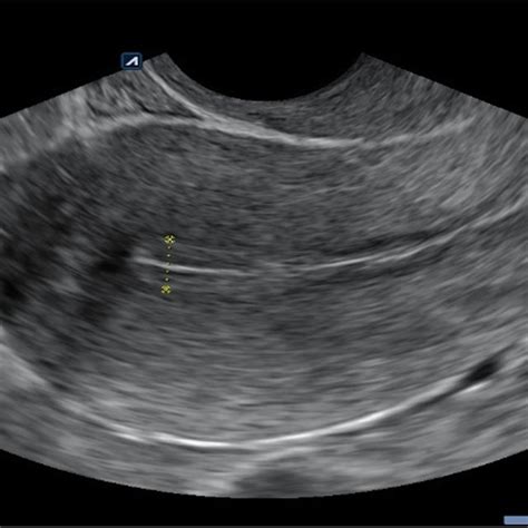 Ultrasound examination showing endometrial thickness in preparation for... | Download Scientific ...