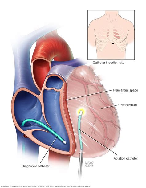 Ablation of AF improves QOL more than drugs - American Nurse Today