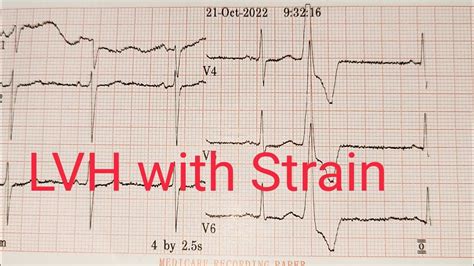 Hypertension || Left Ventricular Hypertrophy with Strain on ECG Strip ...