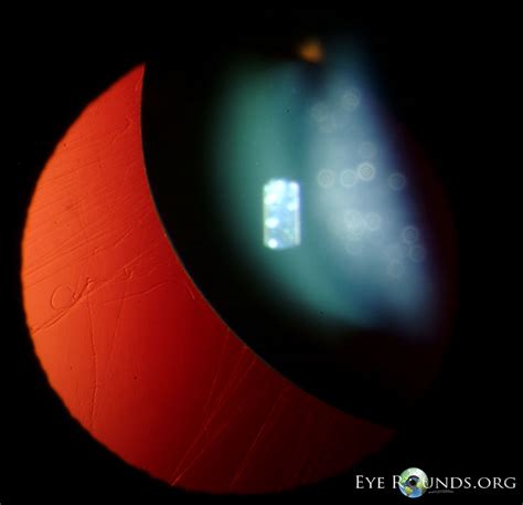 Online Atlas of Ophthalmology :: The University of Iowa, Ophthalmology