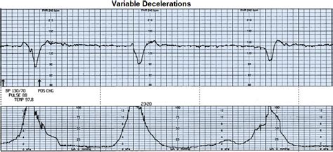 Variable Decelerations- Explained