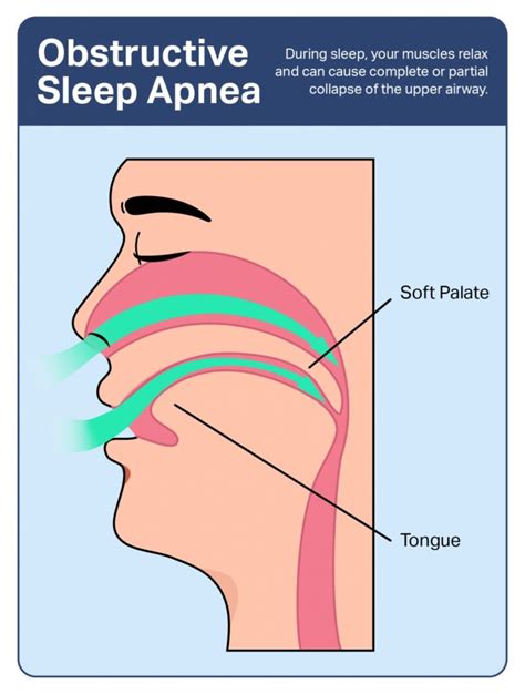 Obstructive Sleep Apnea: Symptoms, Causes, and Treatments