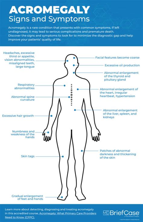 [INFOGRAPHIC] I Spy . . . Acromegaly - MDBriefCase