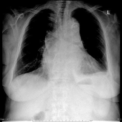 X Ray Images Of Aortic Tear