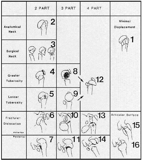 Proximal Humerus Fracture Classification