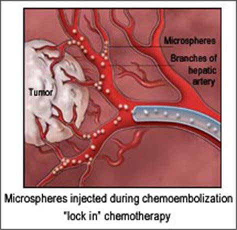 Cancer Types & Treatment Options | Memphis Vascular Center