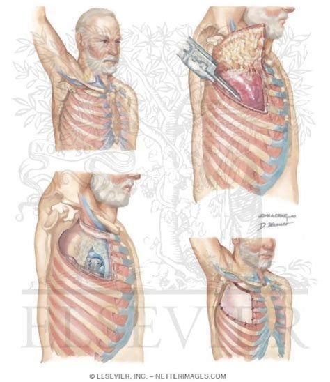 Chest Wall Resection and Reconstruction In Superior Sulcus Tumor