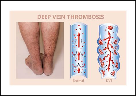 Understanding Phlebitis: Causes, Symptoms, and Complications