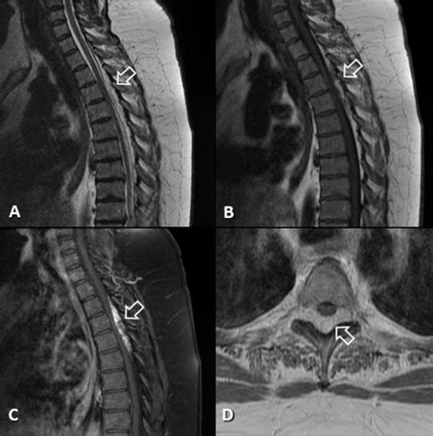 Four cases of spinal epidural angiolipoma - Journal of Clinical ...