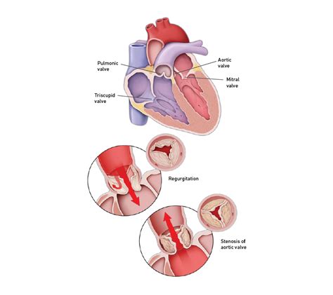 Heart Valve Diseases | Temple Health