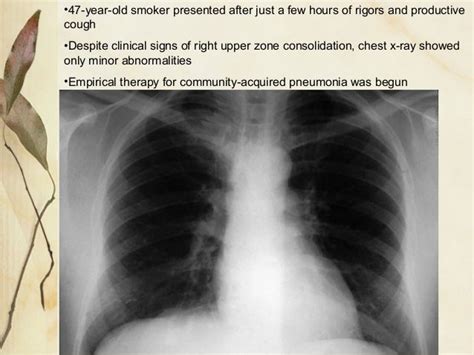 Community acquired pneumonia (cap)