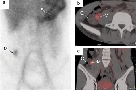 Diagnosis of Meckel's diverticulum by imaging. a Meckel's scan was ...