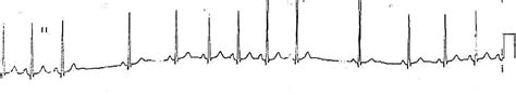 Sinoatrial Exit Block • LITFL • ECG Library Diagnosis