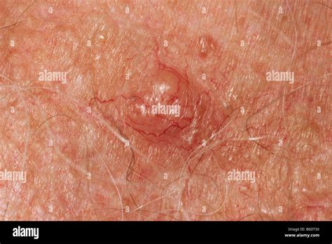 Skin cancer Nodular basal cell carcinoma (BCC) on the chest Stock Photo ...