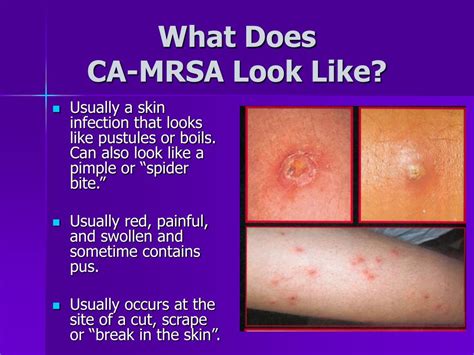 Mrsa Treatment