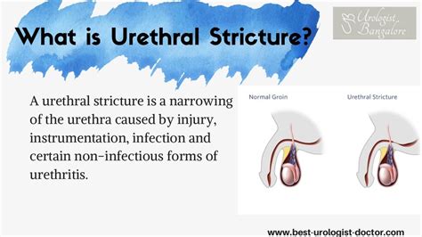 Urethral Stricture Treatment | Best Treatment for Urethral Stricture