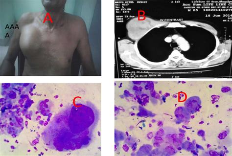 Malignant fibrous histiocytoma, causes, symptoms, diagnosis, treatment & prognosis