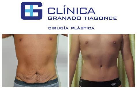 Tummy Tuck in Mexico | The BEST 22 clinics ‎ Prices 2020