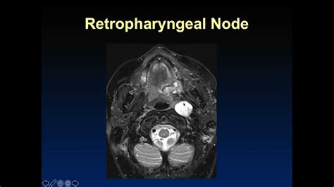 Imaging of Cervical lymphnodes - YouTube