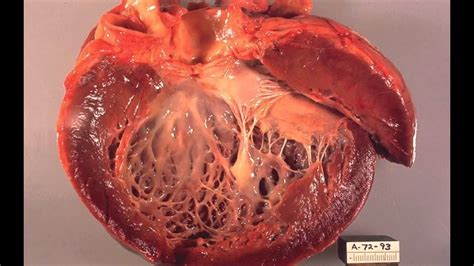 CARDIOMYOPATHY HEART MUSCLE DISEASE - YouTube