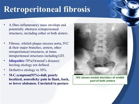 Retroperitoneal mass