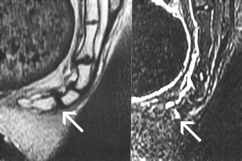 Figure 4 from Magnetic resonance imaging findings in the painful adult ...