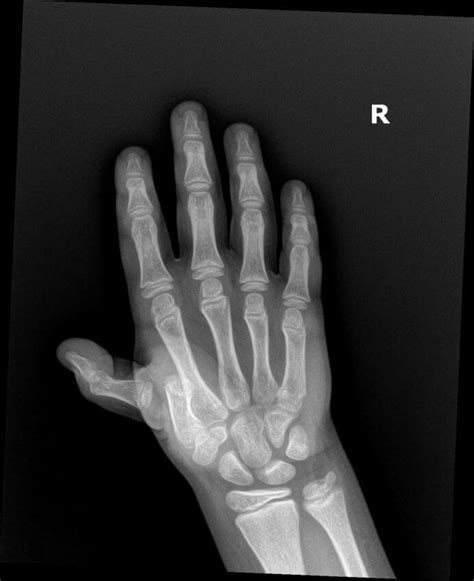 OrthoDx: Thumb Dislocation in Child - Clinical Advisor