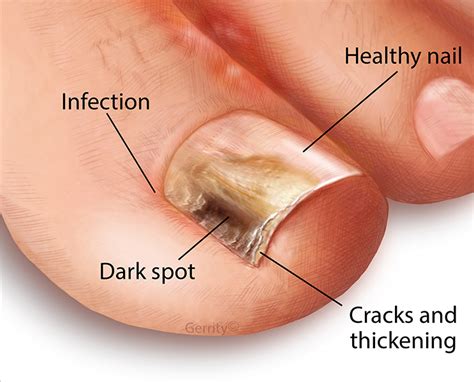 Toenail Fungus | Momentum Foot and Ankle Wellness Center