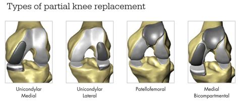 Total Knee Replacement Types