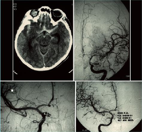 Case 20. Imaging studies. Upper Left: Digital subtraction right ICA... | Download Scientific Diagram