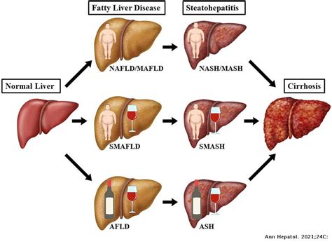 Simultaneous Metabolic and Alcohol-associated Fatty Liver Disease ...