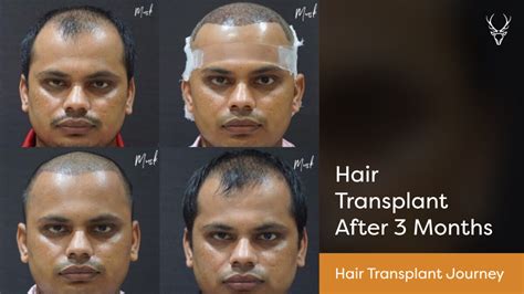 Hair Transplant Journey: Hair Transplant After 3 Months - Results