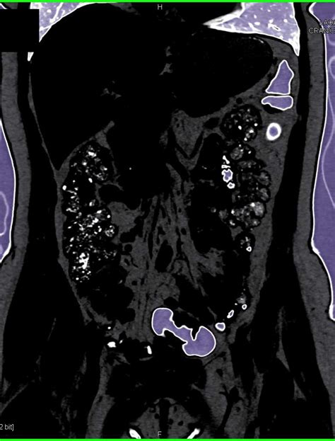 Apple Core Lesion in the Sigmoid Colon - Colon Case Studies - CTisus CT Scanning