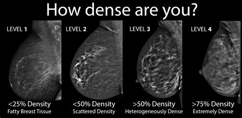 How To Measure Breast Lump Size at Raymond Walker blog