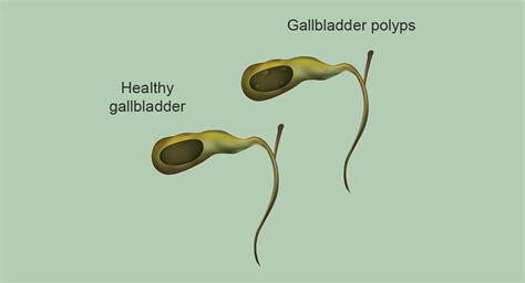 Should You Worry About Gallbladder Polyps? | Liver Doctor