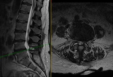 Lumbar laminectomy - Lubbock, Amarillo, Midland | Sergiy Nesterenko, M.D