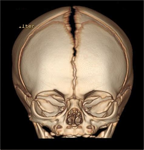 A 3D CT scan of a patent metopic suture in a 25-day-old patient, the... | Download Scientific ...